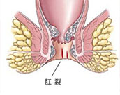 合肥治疗肛裂 合肥肛肠专科医院 合肥肛门医院哪家好