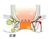 合肥治疗肛瘘 合肥肛肠医院 合肥肛门医院哪家好