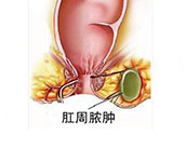 合肥治疗痔疮疾病 合肥肛肠医院 合肥中山医院肛肠科