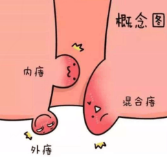 合肥肛门检查