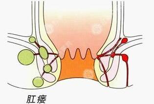 合肥治疗肛瘘 合肥肛肠医院